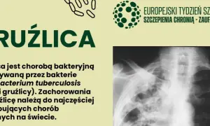 Gruźlica to choroba bakteryjna. Na zdjęciu RTG klatki piersiowej widoczne są zmiany typowe dla gruźlicy.