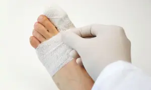 Dłoń w białej rękawiczce opatruje palce stopy, które mogą być dotknięte martwicą.