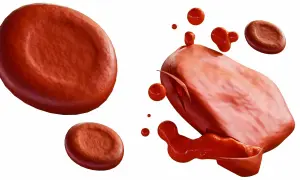 Czerwone krwinki, jedna z nich pęka, uwalniając zawartość. To obraz hemolizy, rozpadu komórek krwi.