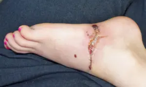 Stopa z raną pooperacyjną, która zaczyna wykazywać objawy gangreny. Widoczne są ciemne, martwicze tkanki.