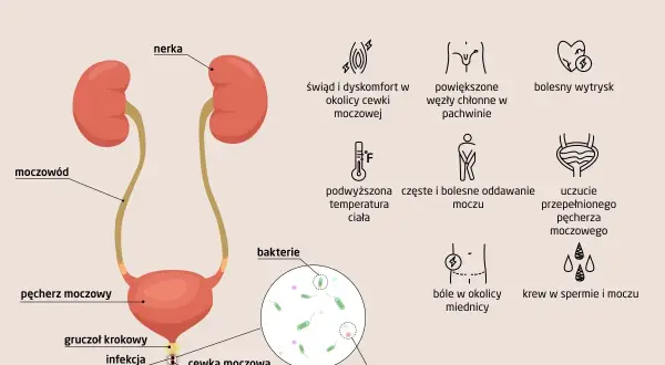 Objawy zapalenia cewki moczowej: dyskomfort, ból, gorączka, krew w moczu, obecność bakterii i białych krwinek.