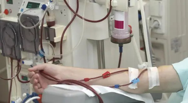 Ramię pacjenta podłączone do maszyny do dializy. Czerwone i niebieskie złącza przewodów widoczne na skórze.