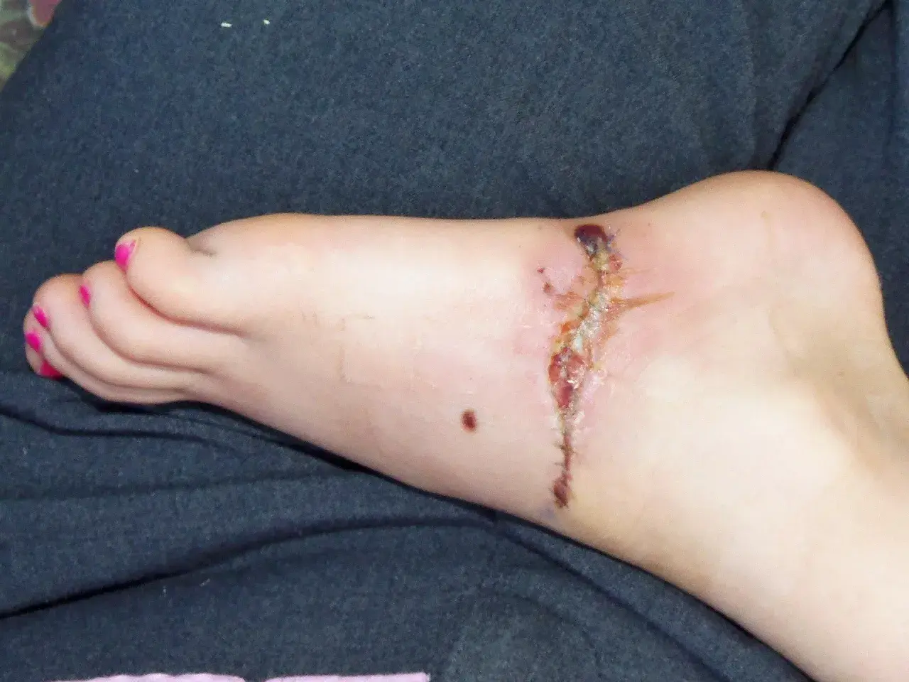 Stopa z raną pooperacyjną, która zaczyna wykazywać objawy gangreny. Widoczne są ciemne, martwicze tkanki.